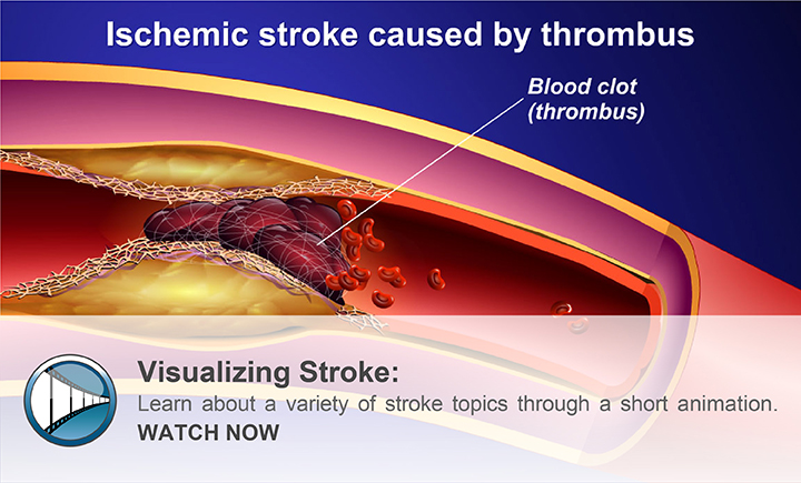Visualizing Stroke: Learn about a variety of stroke topics through a short animation. WATCH NOW